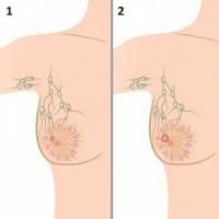 स्तन कैंसर के चरण (डिग्री) चरण 2 स्तन कैंसर वे कितने समय तक जीवित रहते हैं?