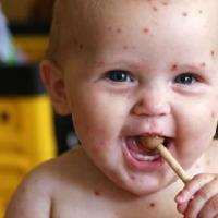 Симптоми на варицела при дете и нейното лечение